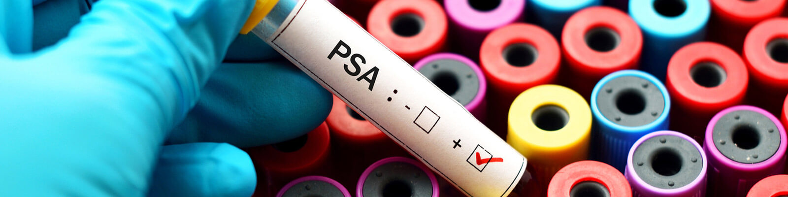 PSA Test: What The Prostate Specific Antigen Blood Test Is