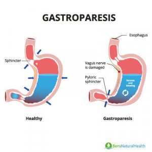 Gastroparesis, A Lesser Known Diabetes Complication