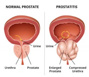 Does Zinc Work for Treating Prostatitis? - Ben's Natural Health