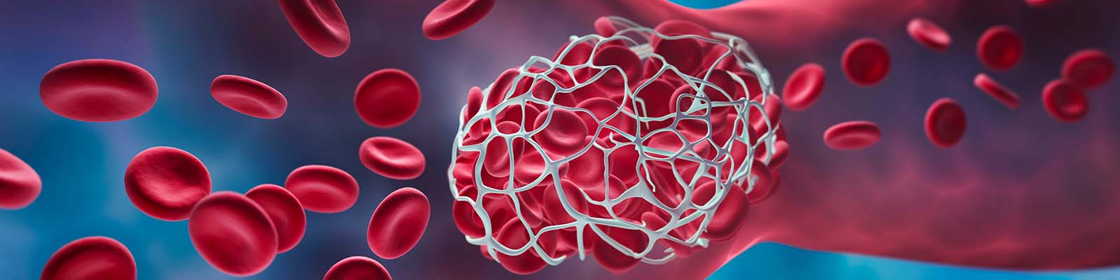 How to Prevent Blood Clots: 6 Ways to Reduce Your Risk